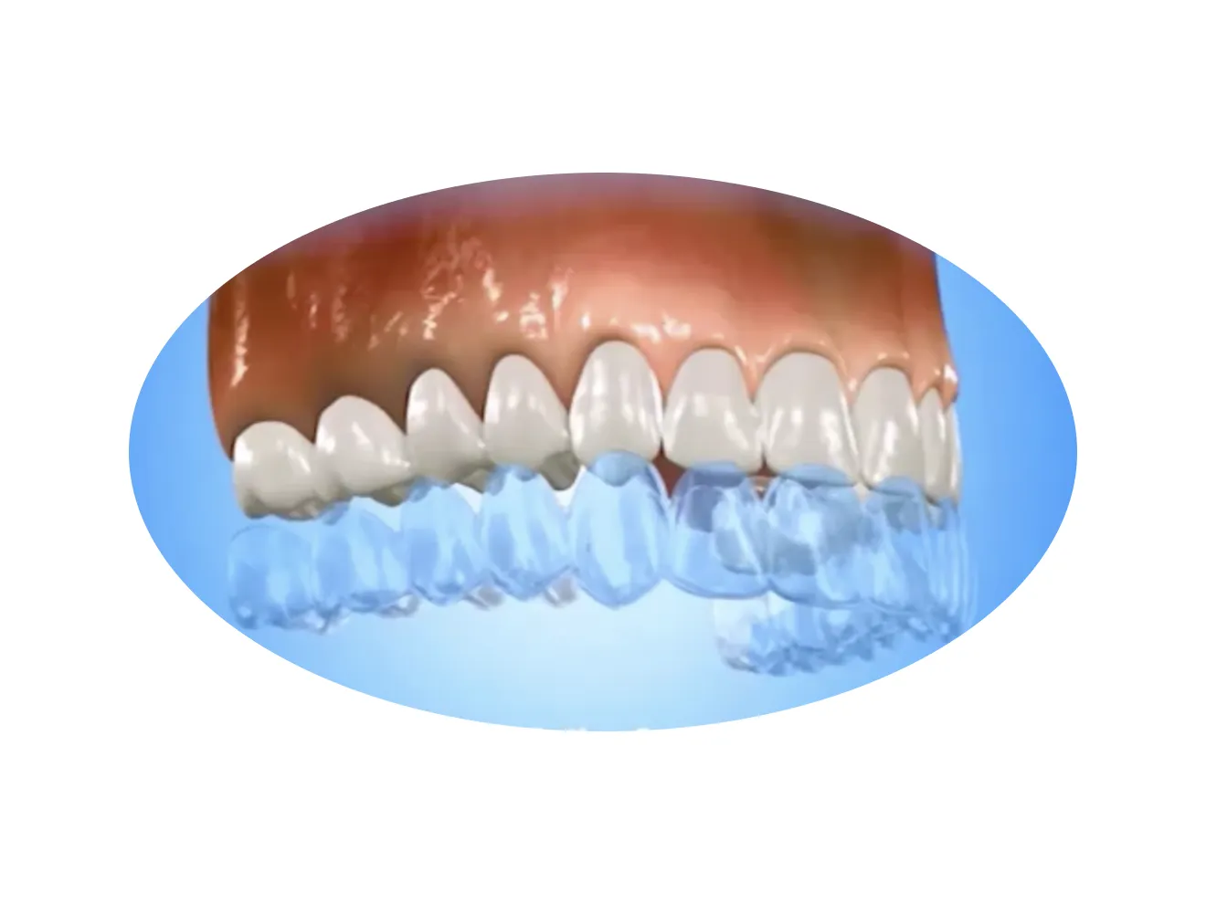 Clear dental aligners are being fitted over upper teeth.
